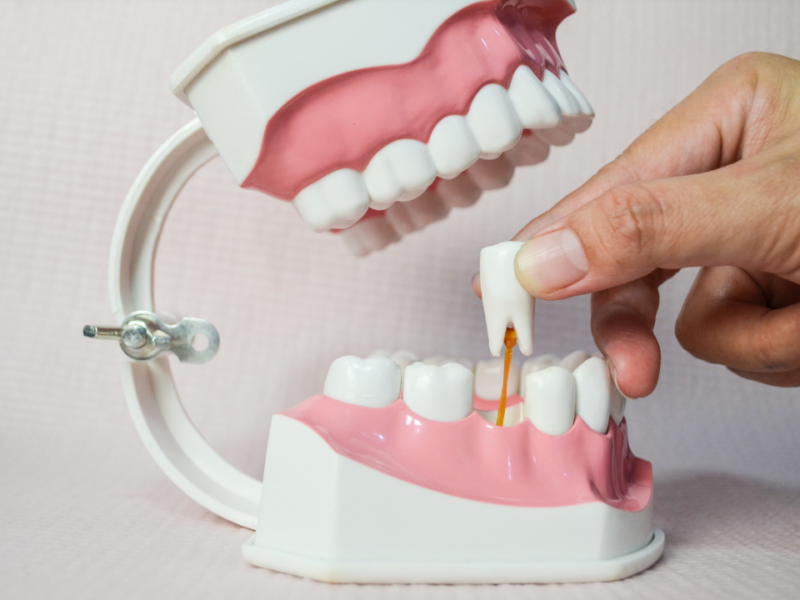 estrazione denti